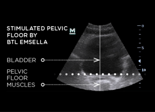 Esmella After Ultrasound Image