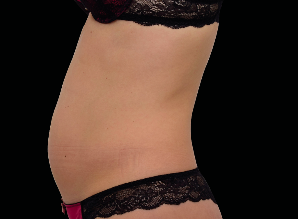 Body Sculpting Example