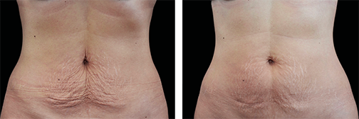 Body Sculpting Example