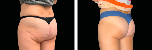 Body Sculpting Example